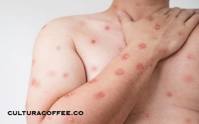mpox in africa